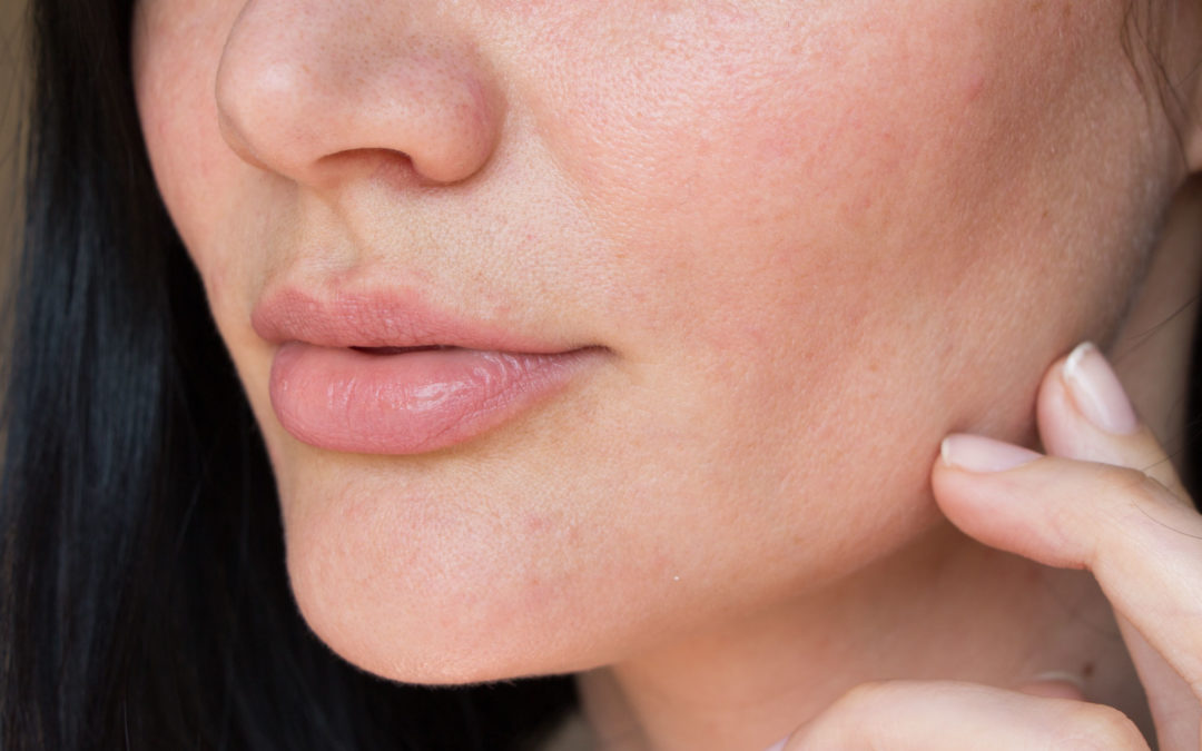 Lip Fillers: 7 Questions Answered