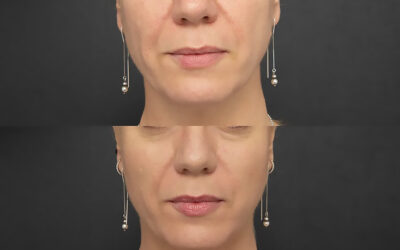 A ‘facelift’ without surgery